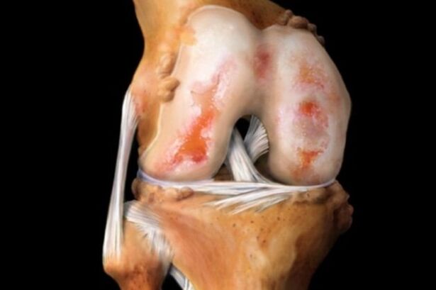Destrucción de la articulación de la rodilla debido a artrosis una patología común del sistema musculoesquelético