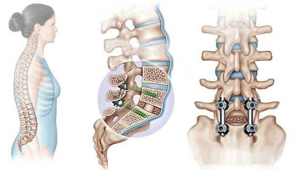 Fijación de vértebras desplazadas con implantes en estadio avanzado de osteocondrosis. 