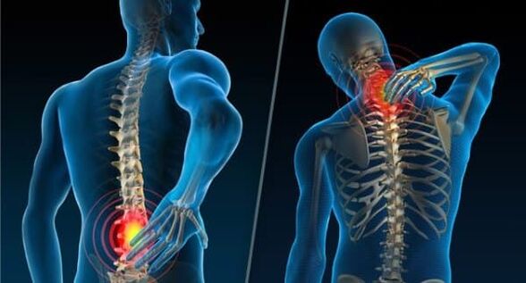 Signos que indican el desarrollo de osteocondrosis dolor en el cuello y la espalda baja. 