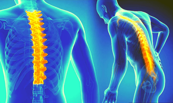 Osteocondrosis de la columna