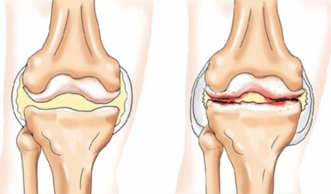 Diferencias en la artritis y la artrosis
