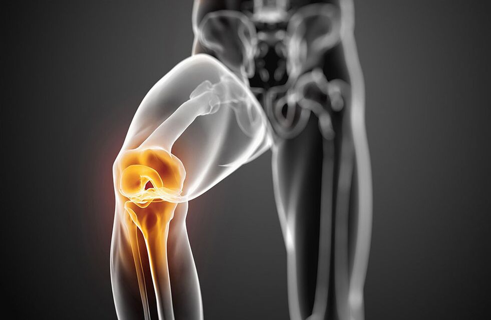 Artrosis de la articulación de la rodilla