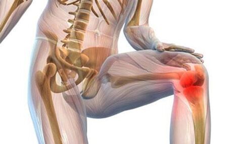 Artrosis de la articulación de la rodilla