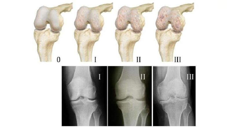Etapas de artrosis de la articulación de la rodilla en radiografías.