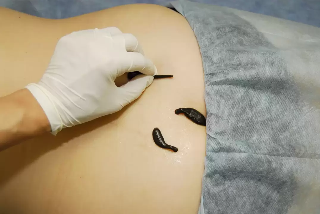 colocación de sanguijuelas para la osteocondrosis lumbar