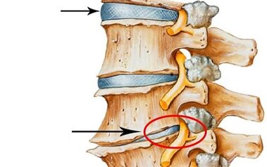 etapas de desarrollo de la osteocondrosis cervical