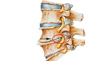 causas de la osteocondrosis cervical