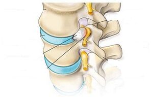 principales síntomas de la osteocondrosis cervical