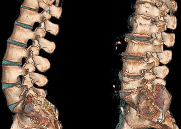 Tomografía computarizada de la columna lumbar en condiciones normales y con osteocondrosis