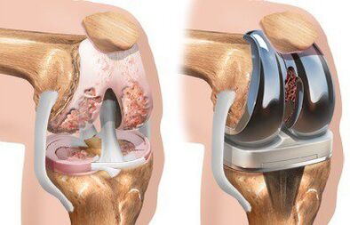 Endoprótesis de la articulación de la rodilla con gonartrosis. 