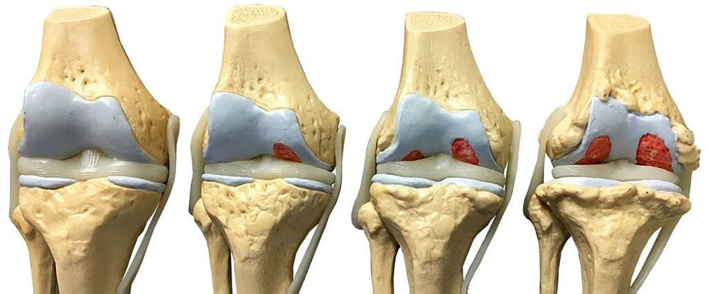 Grados de artrosis de la articulación de la rodilla. 